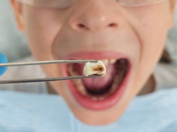 Best Emergency Tooth Extraction in Dumas, TX
